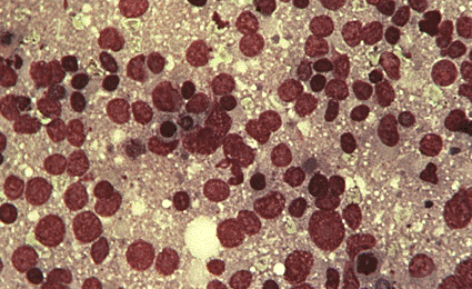 Imagen: Microfotografía de luz de células cancerosas removidas del seno de una mujer por biopsia de aspiración de aguja fina (Foto cortesía de Cecil Fox / SPL). Imagen: Microfotografía de luz de células cancerosas removidas del seno de una mujer por biopsia de aspiración de aguja fina (Foto cortesía de Cecil Fox / SPL).